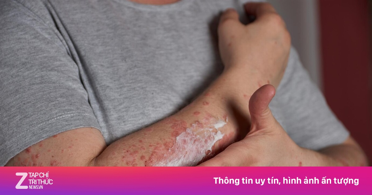 Ghẻ là bệnh gì?