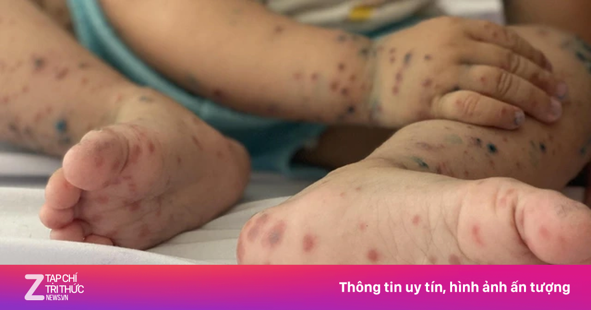 Bệnh tay chân miệng gia tăng, phụ huynh cần làm gì?