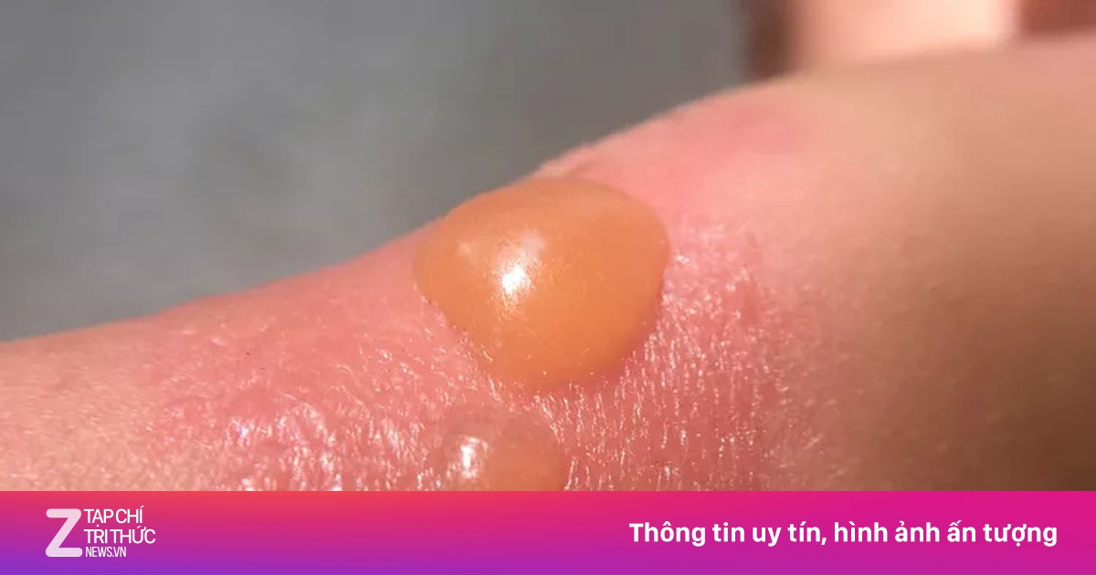 Trị phồng rộp da do cháy nắng