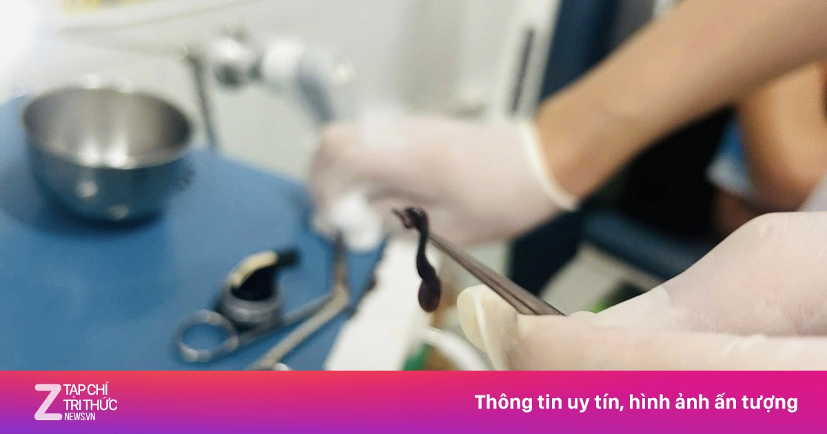 Gắp con đỉa dài 5 cm ký sinh trong mũi bé trai