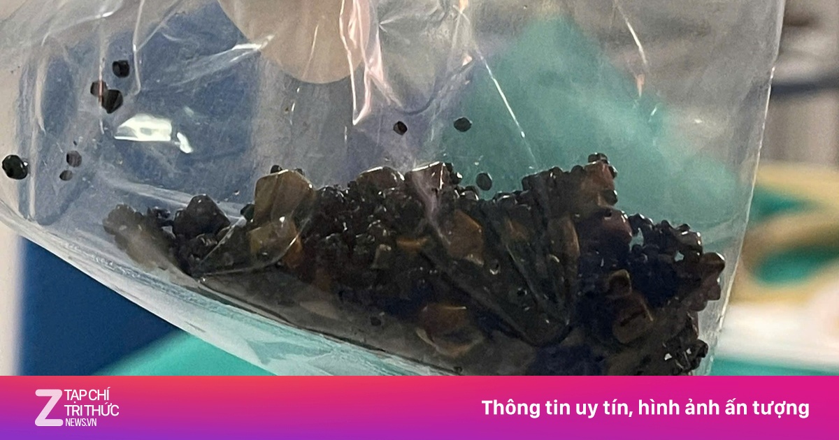 Hàng trăm viên sỏi trong túi mật người phụ nữ
