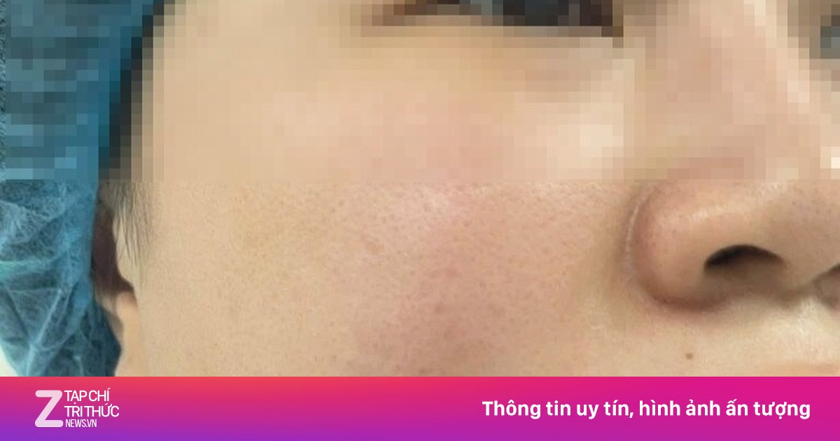 Người phụ nữ nhập viện sau khi làm đẹp tại spa