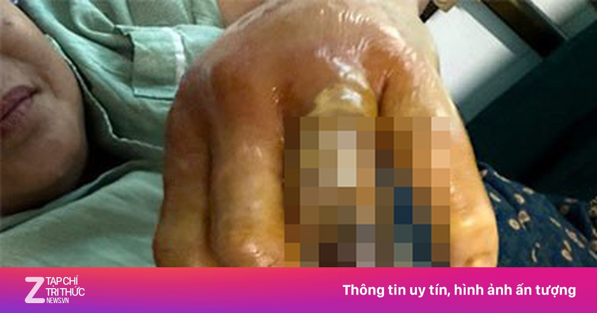 Nhiễm khuẩn, viêm hoại tử bàn tay sau khi bị gai cá đâm
