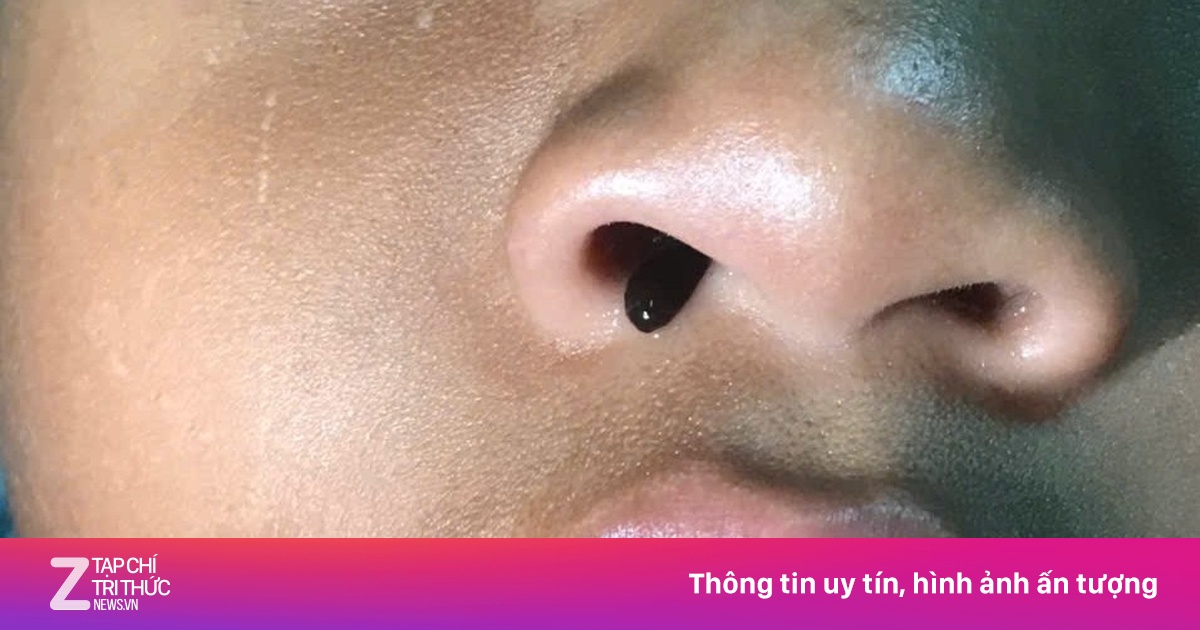 Ho ra máu một tuần, bé trai được phát hiện có đỉa sống trong mũi