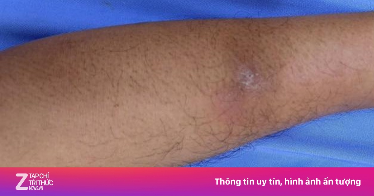 Sán 'đục lỗ' trên cơ thể người đàn ông có thói quen ăn đồ sống