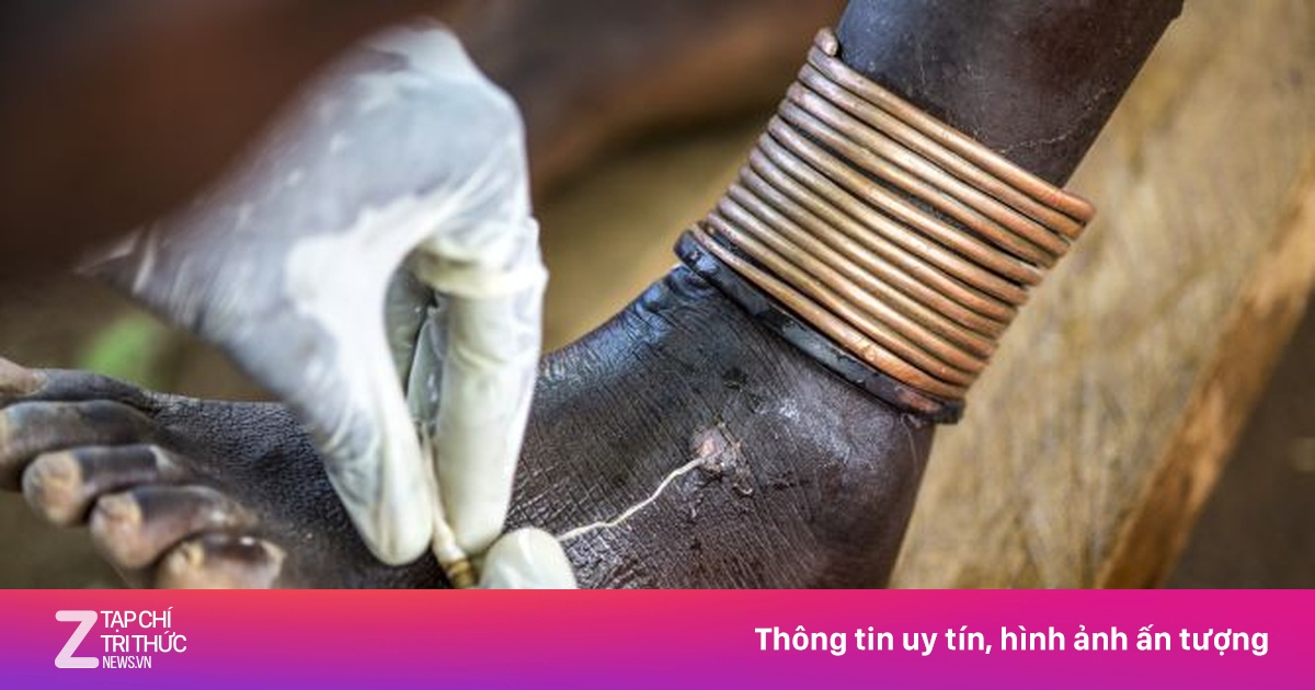 Loại ký sinh trùng nguy hiểm từng bị bỏ quên tái xuất ở Việt Nam