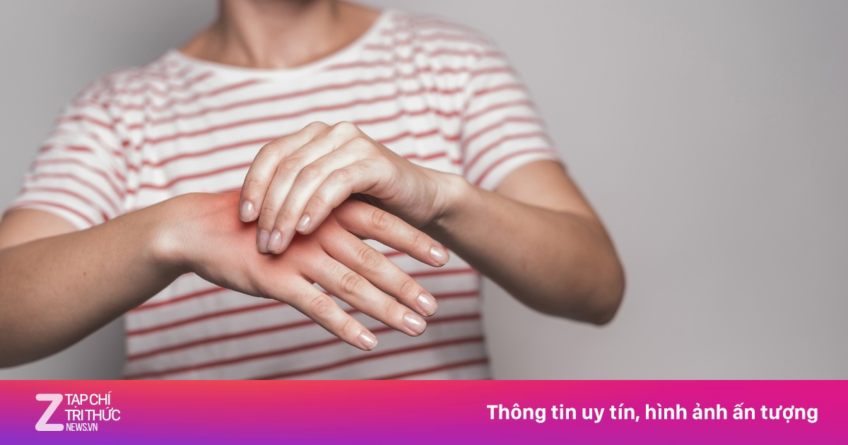 Thời điểm bệnh gout dễ khởi phát