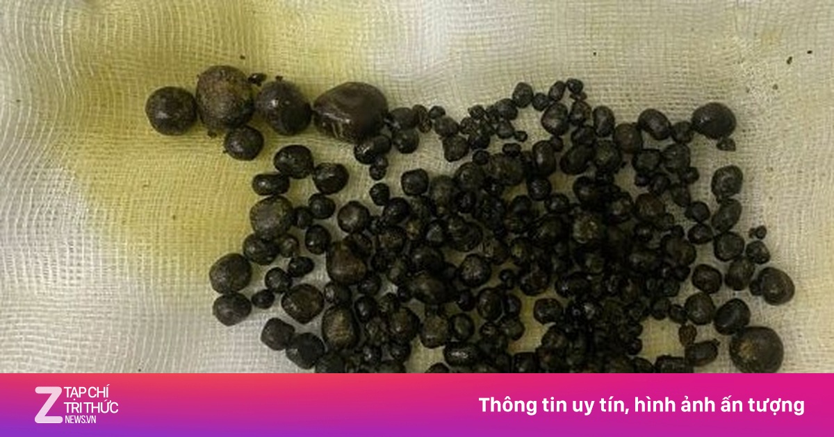 Gần 400 viên sỏi trong túi mật người phụ nữ