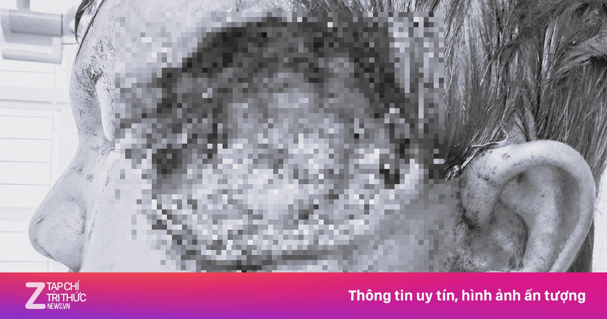 Hàng chục con dòi ký sinh trong gò má người đàn ông