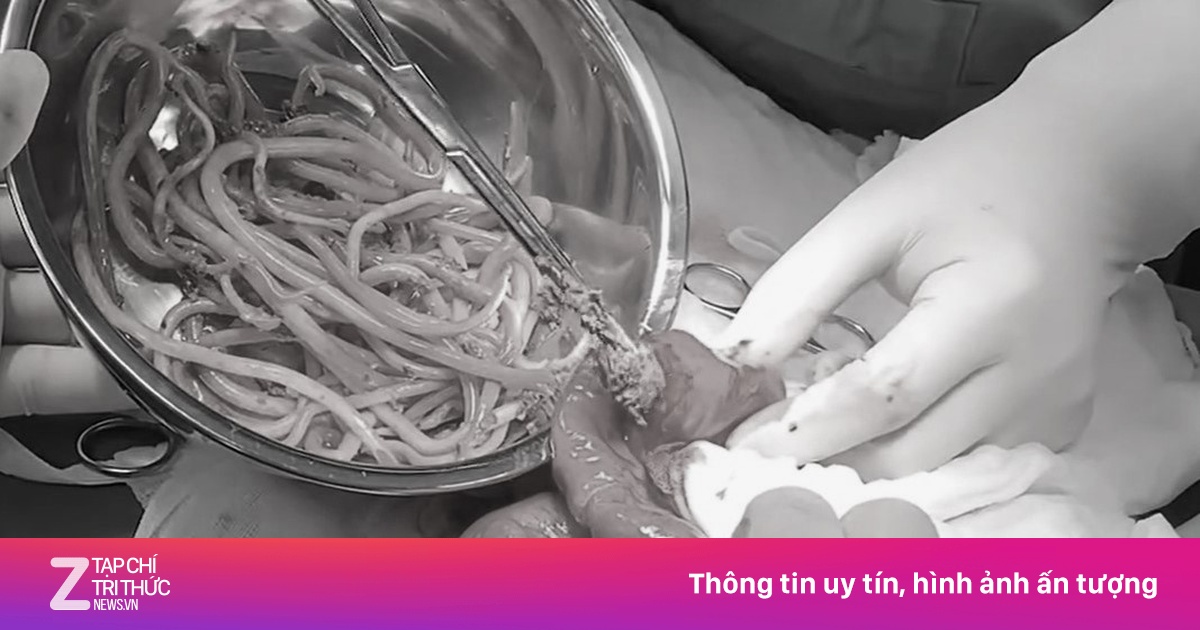 Thiếu niên 15 tuổi bị loét ruột nặng do giun đũa ký sinh, bác sĩ phẫu thuật cấp cứu