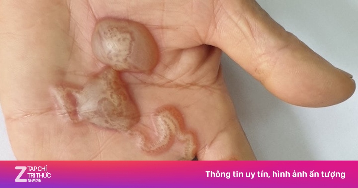 Căn bệnh 'ám ảnh' người yêu chó mèo, hàng chục nghìn ca mắc mỗi năm