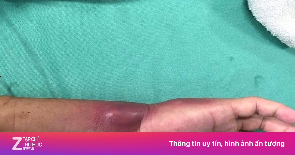 2 ca nhiễm vi khuẩn ‘ăn thịt người’ ở Đắk Lắk