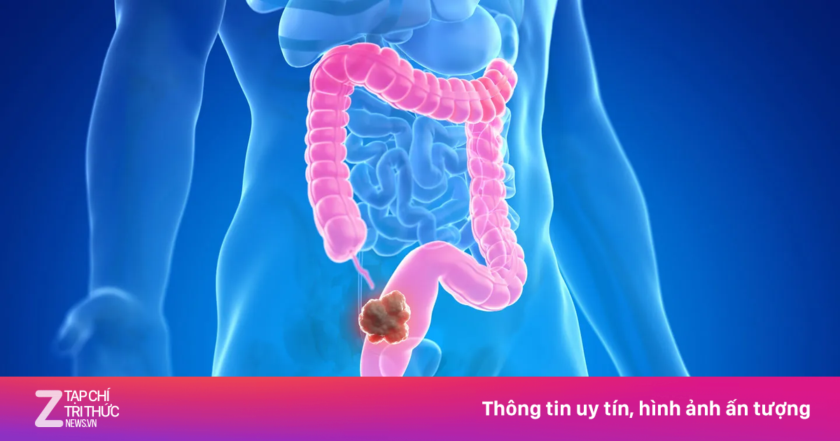 Ung thư đại trực tràng tăng nhanh ở người trẻ: Báo động toàn cầu và câu chuyện từ diễn viên James Van Der Beek