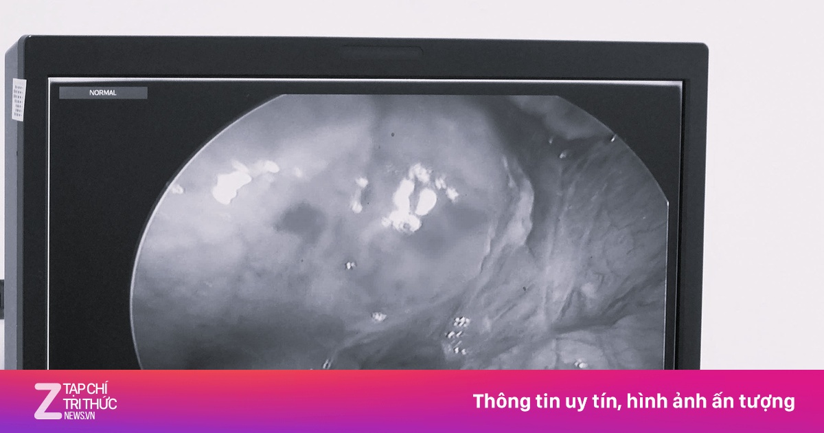 Thủng dạ dày vì thói quen nhiều người mắc phải khi đau