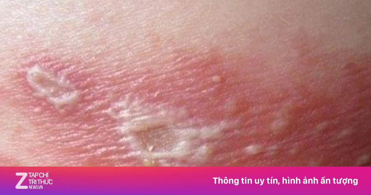 Zona gây đau đớn đến mức nào?