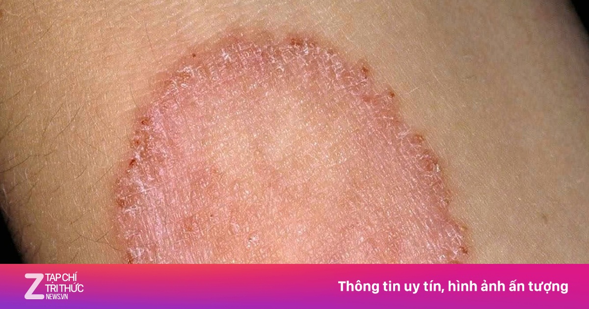 Dấu hiệu nổi bật của bệnh lác đồng tiền và cách xử trí