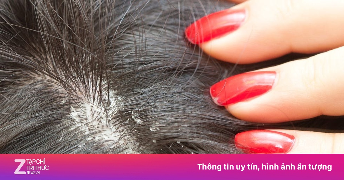 Nhập viện khẩn cấp sau khi ủ tóc diệt chấy