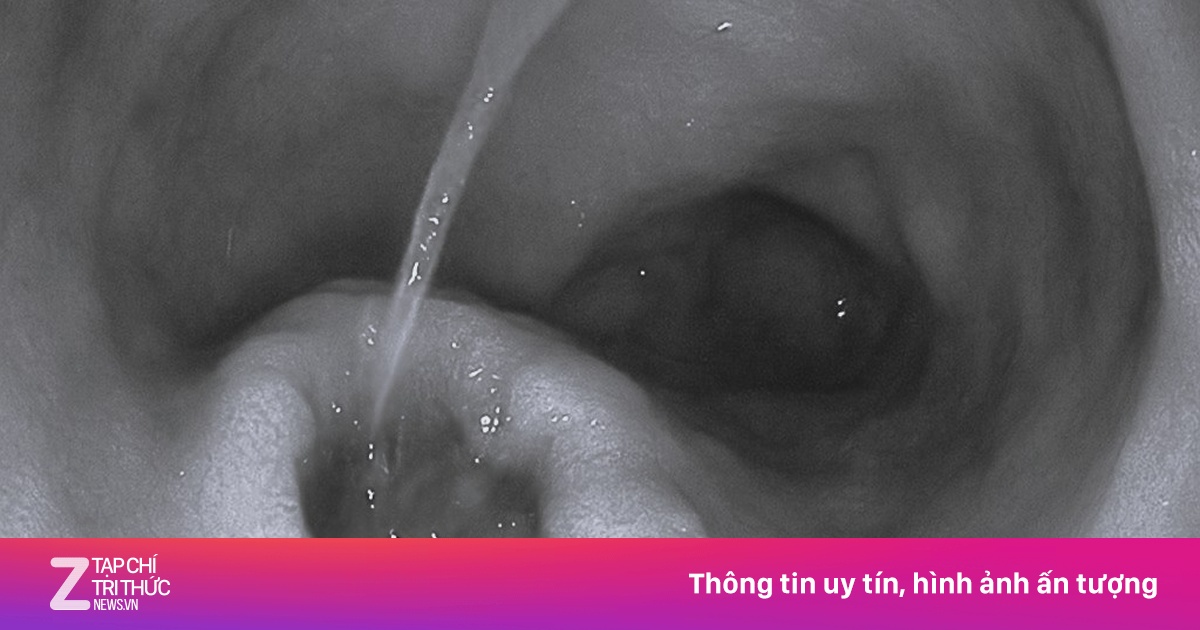 Dạ dày loét nặng vì thói quen phổ biến của người Việt khi đau