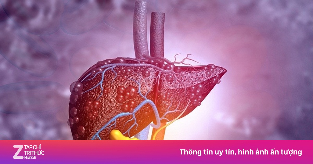 Không một giọt rượu, căn bệnh này vẫn âm thầm làm hỏng gan