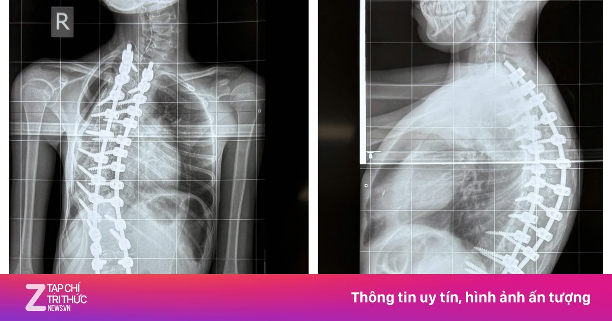 Bé gái mắc bệnh hiếm, bác sĩ BV Nhi đồng 1 lần đầu gặp