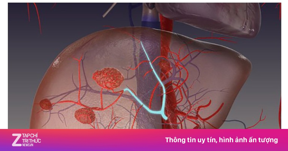 Đau tức hạ sườn, ăn kém, sút cân… là dấu hiệu bệnh gì?