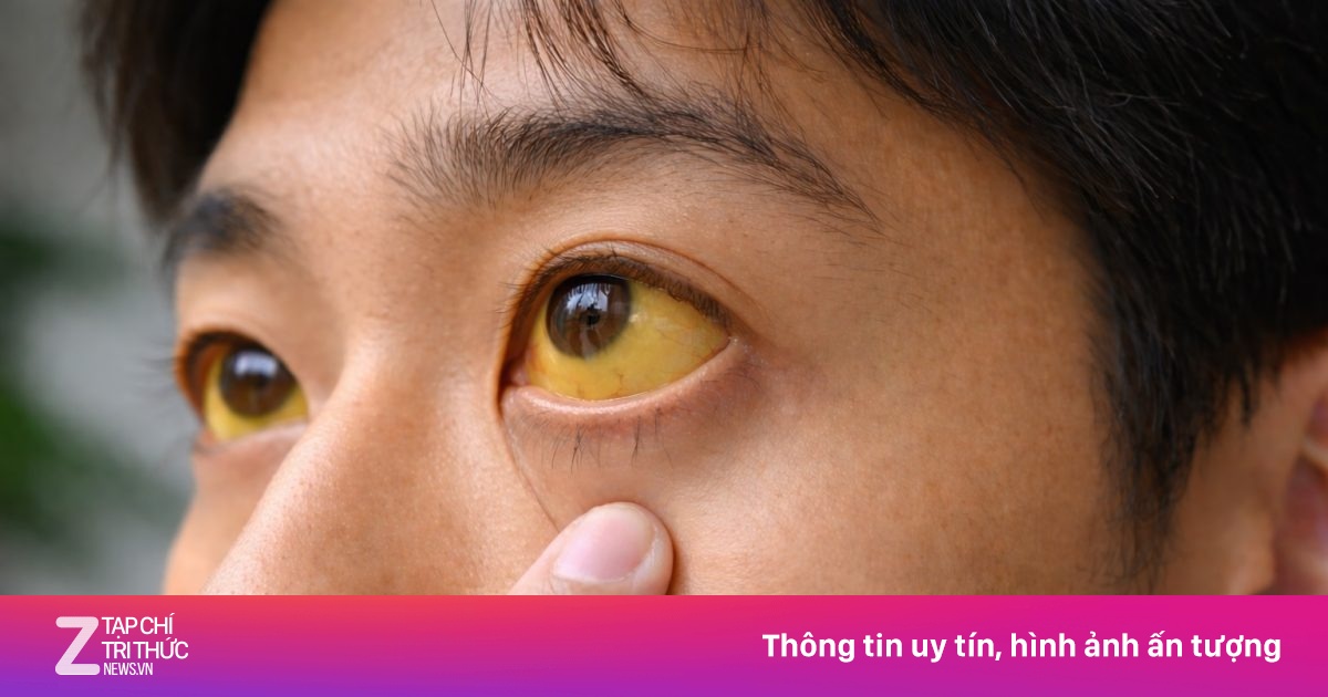 Căn bệnh về gan có thể gây ung thư, khó phát hiện ở giai đoạn đầu