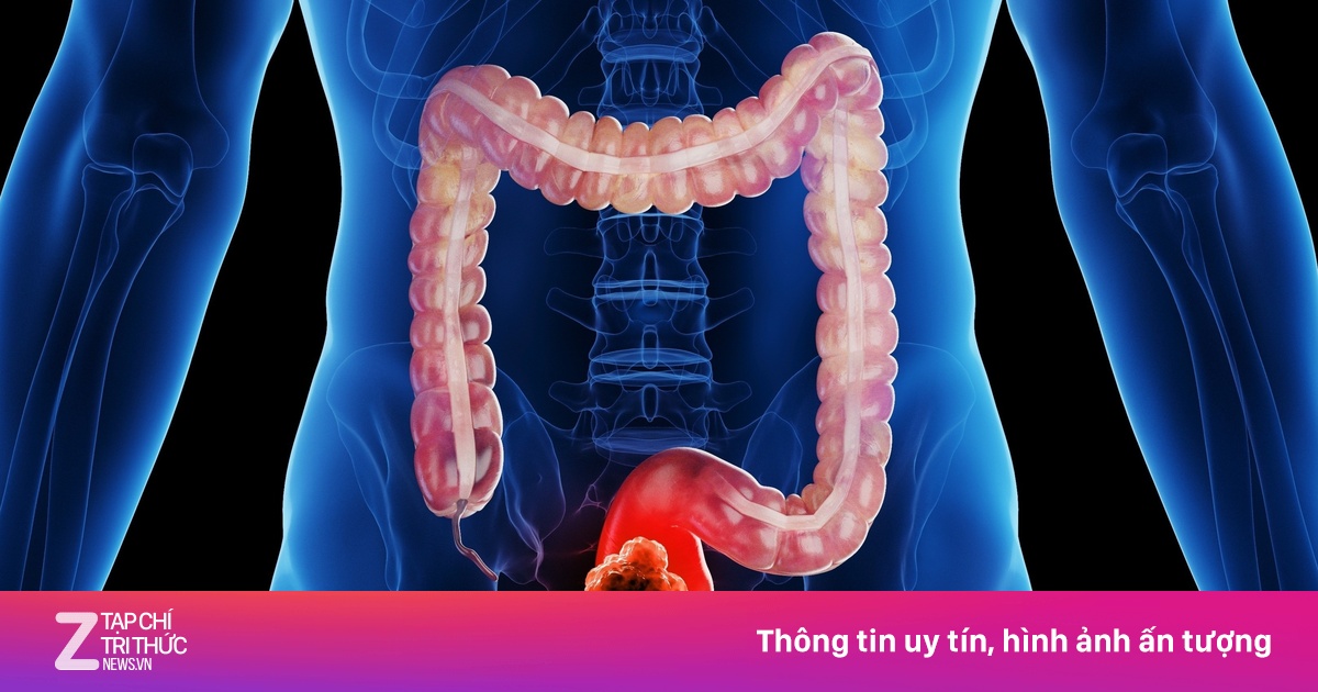 Một loại ung thư đang tăng nhanh báo động ở người trẻ