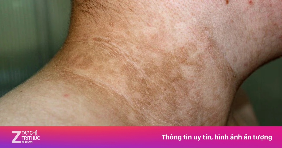 Dấu hiệu trên da chứng tỏ cơ thể bạn đang kháng insulin