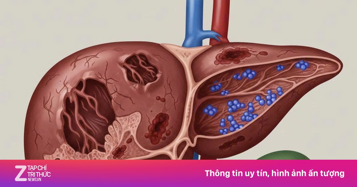 Nguy cơ tổn thương gan từ những bữa tiệc