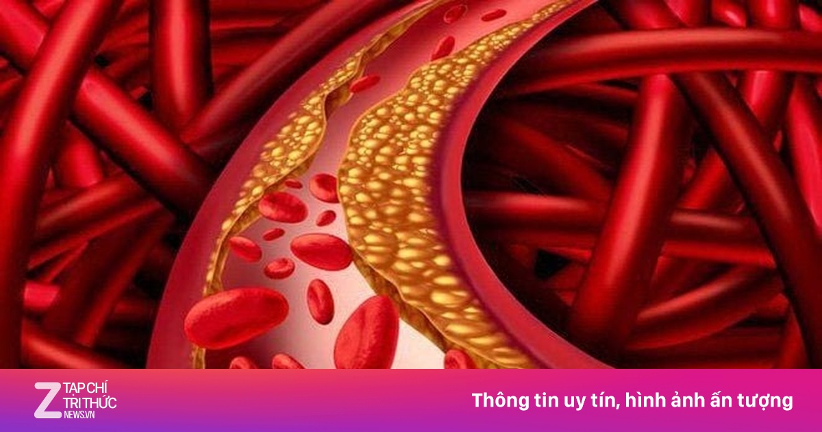 Cách Ăn Uống Giảm Mỡ Máu Xấu, Phòng Ngừa Đột Quỵ Hiệu Quả