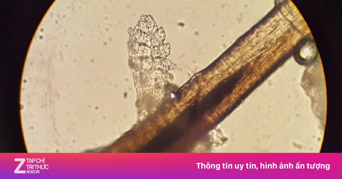 Hơn 60 con rận làm tổ trong mí mắt cô gái trẻ sau nối mi