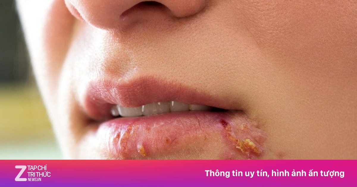 Chịu hậu quả vĩnh viễn vì chủ quan với nốt mụn rộp do Herpes