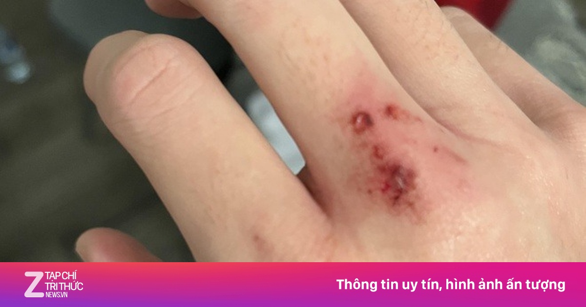 Con chó nghi dại cắn liên tiếp 6 người cùng một xã