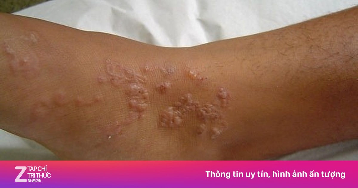 Giun chi chít, gồ ghề dưới da suốt 2 năm nhưng không hay biết