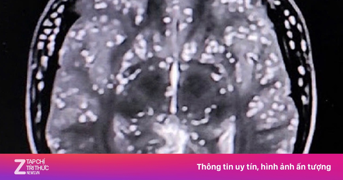 Món khoái khẩu khiến sán làm tổ trong não người đàn ông