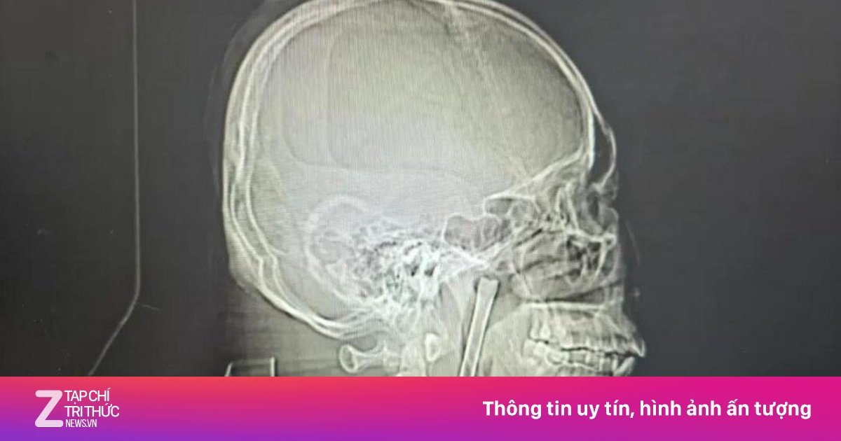 Chiếc đũa dài 12 cm mắc kẹt trong cổ họng người đàn ông suốt 8 năm