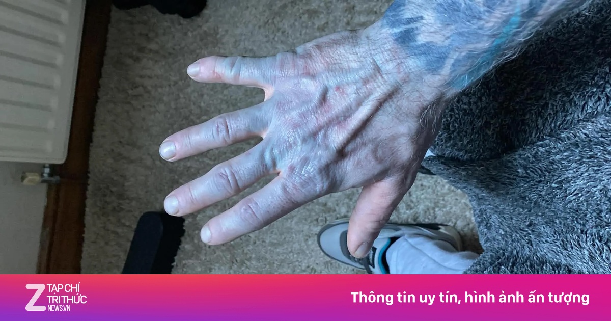 Hốt hoảng nhập viện vì da xanh như nhân vật Avatar