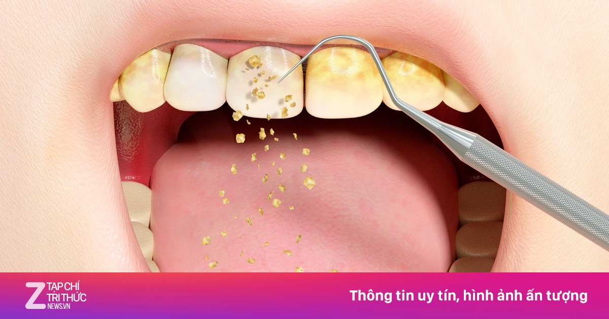 Hậu quả khôn lường khi bỏ qua việc lấy cao răng định kỳ