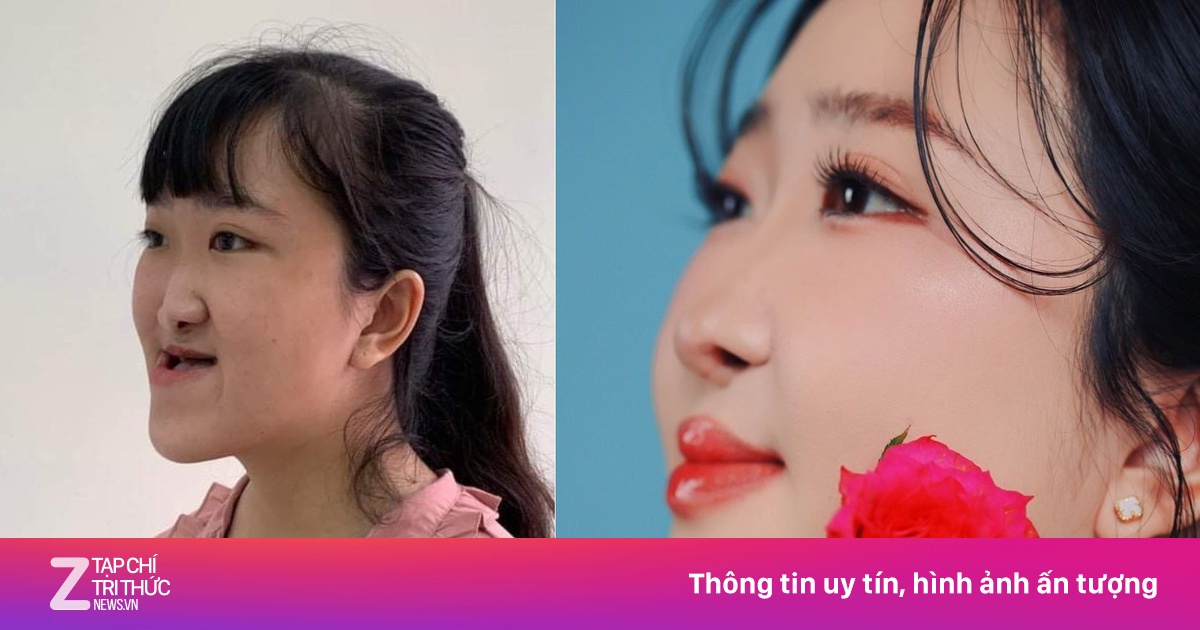 Cô gái 25 tuổi 'lột xác' sau 4 lần phẫu thuật hàm mặt