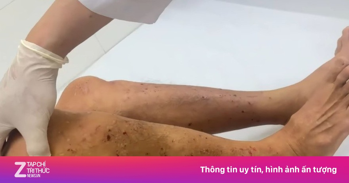 Người đàn ông nhiễm cùng lúc sán dây chó và giun đũa