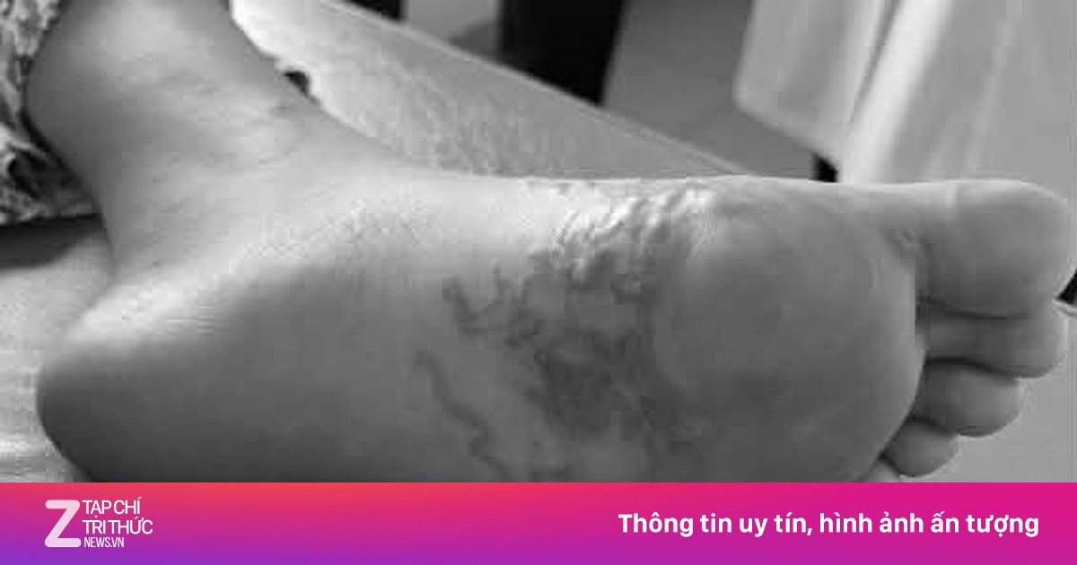 Nhiễm cùng lúc 5 loại ký sinh trùng vì món ăn nhiều người thích