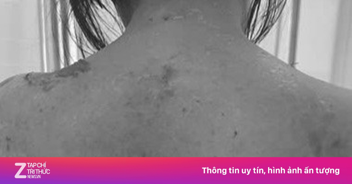Người phụ nữ suýt mất mạng vì tự uống thuốc dị ứng sau bữa lẩu