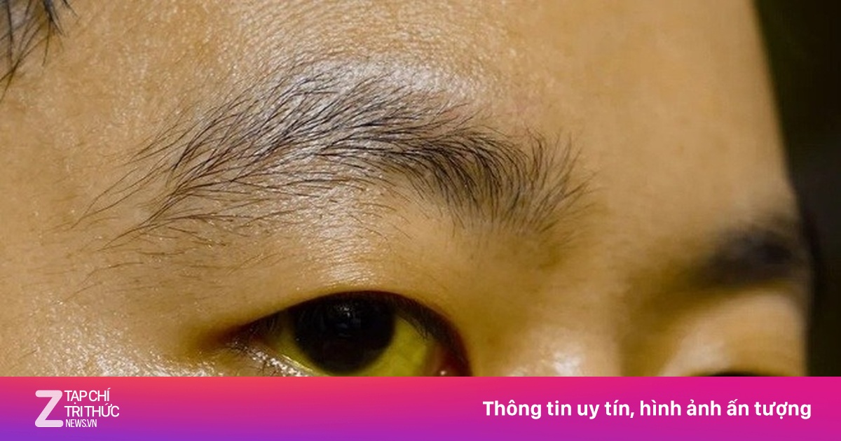 Dấu hiệu bệnh gan biểu hiện ngay ở mắt