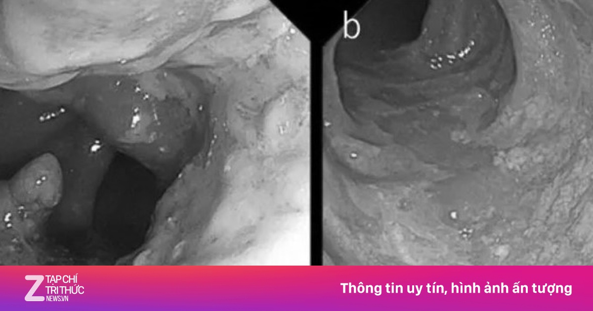 Ung thư trực tràng gia tăng ở người trẻ, cảnh báo từ chuyên gia