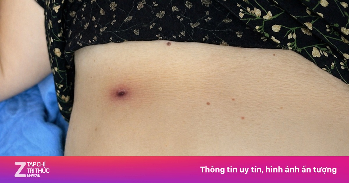 Bệnh nhân 64 tuổi tổn thương gan sau 4 ngày bị mò đốt ở bụng