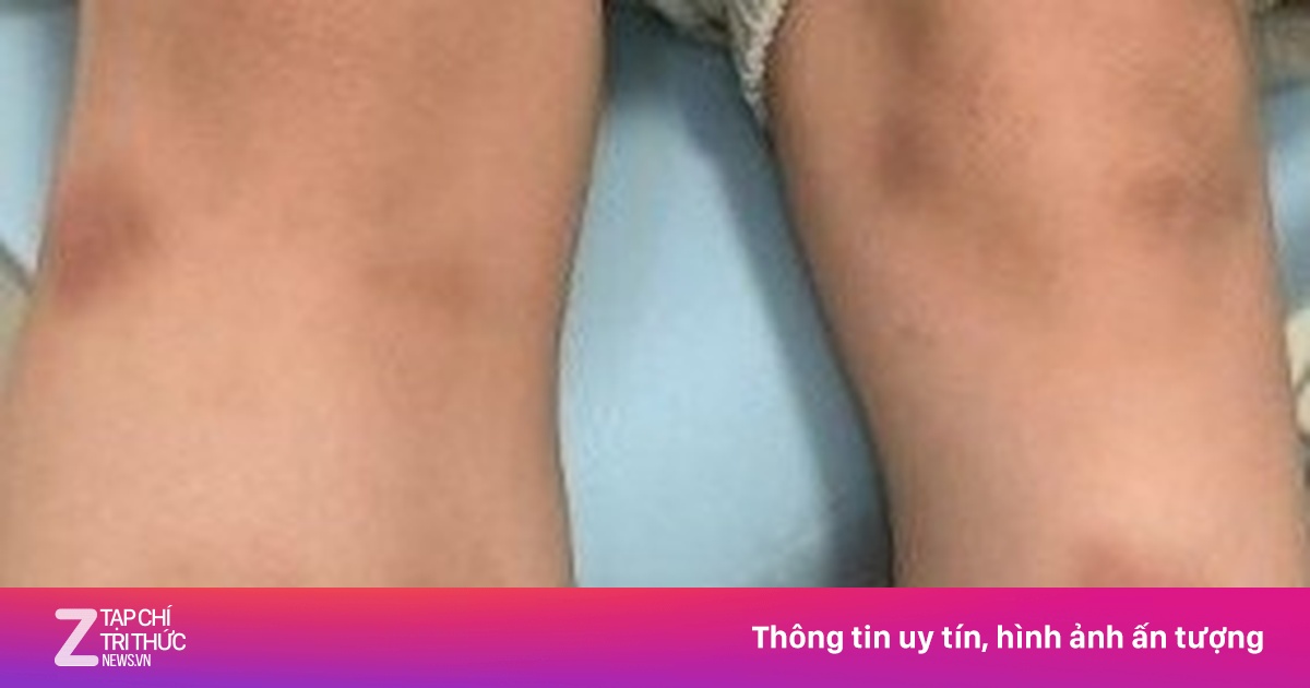 Bé trai 6 tuổi nổi bầm tím khắp người sau ăn thịt nướng cuốn rau sống