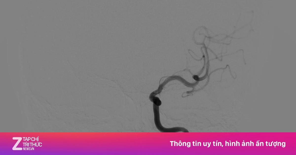 Đột quỵ ở tuổi 33