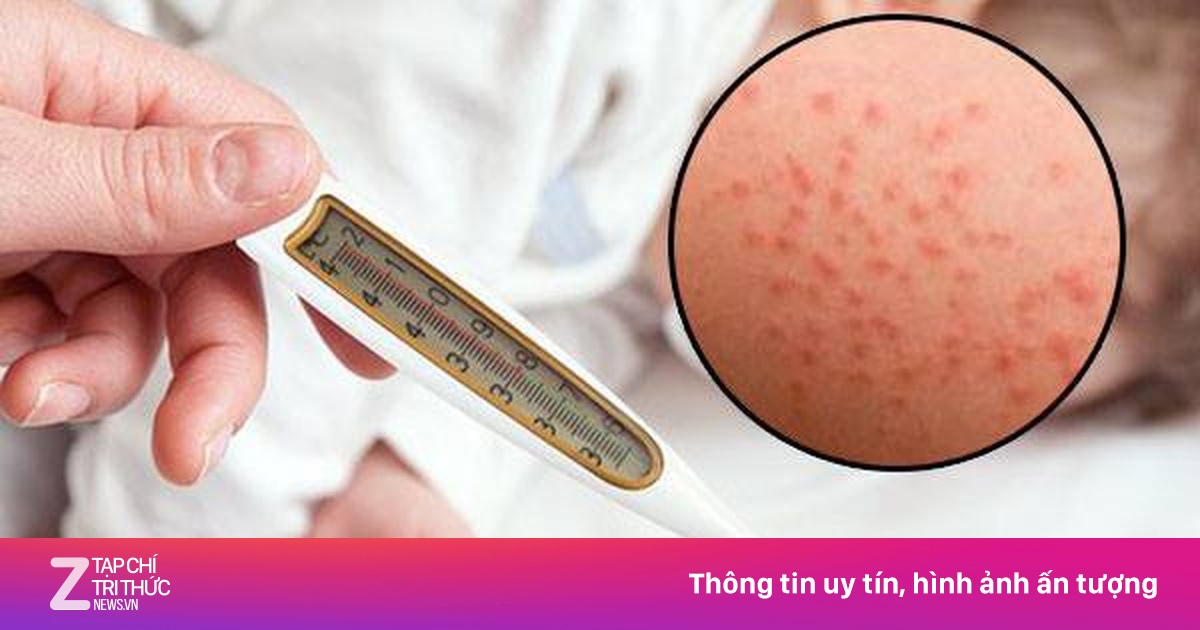 Khuyến cáo về cách bổ sung vitamin A cho trẻ mắc bệnh sởi