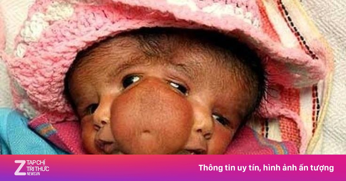 Bé gái có 2 mặt ở Ấn Độ được tôn là nữ thần - Bệnh thường gặp - ZNEWS.VN 