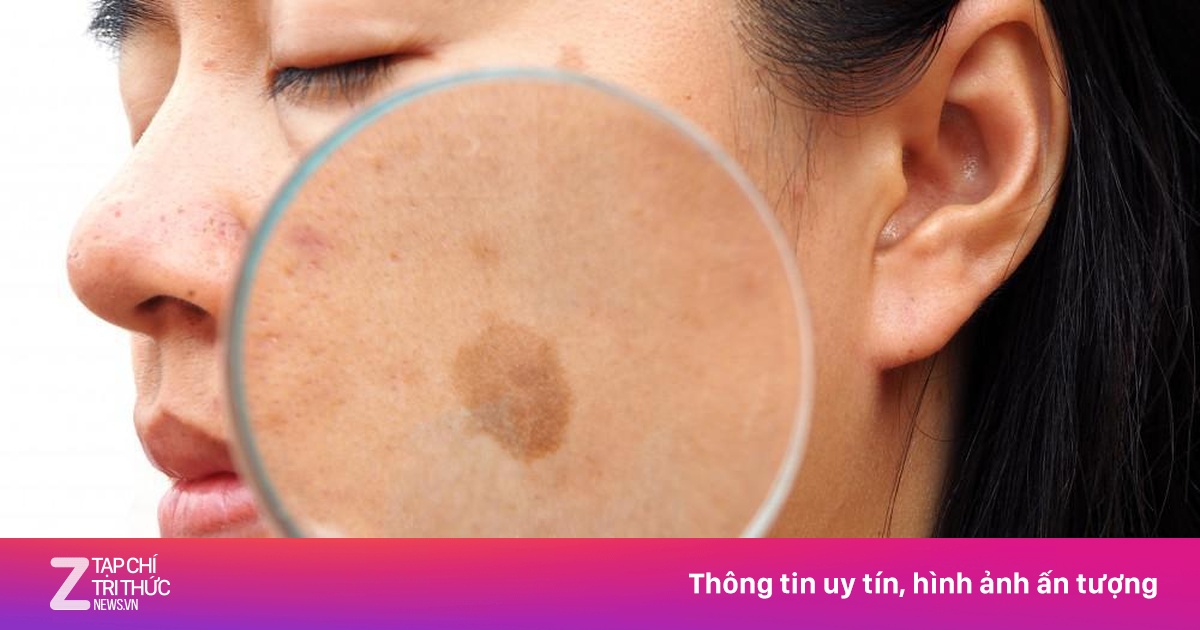 Vì sao phụ nữ dễ bị nám da khi mang thai?